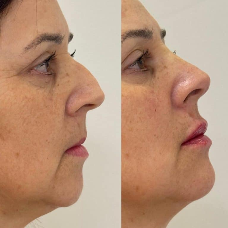 Harmonização facial