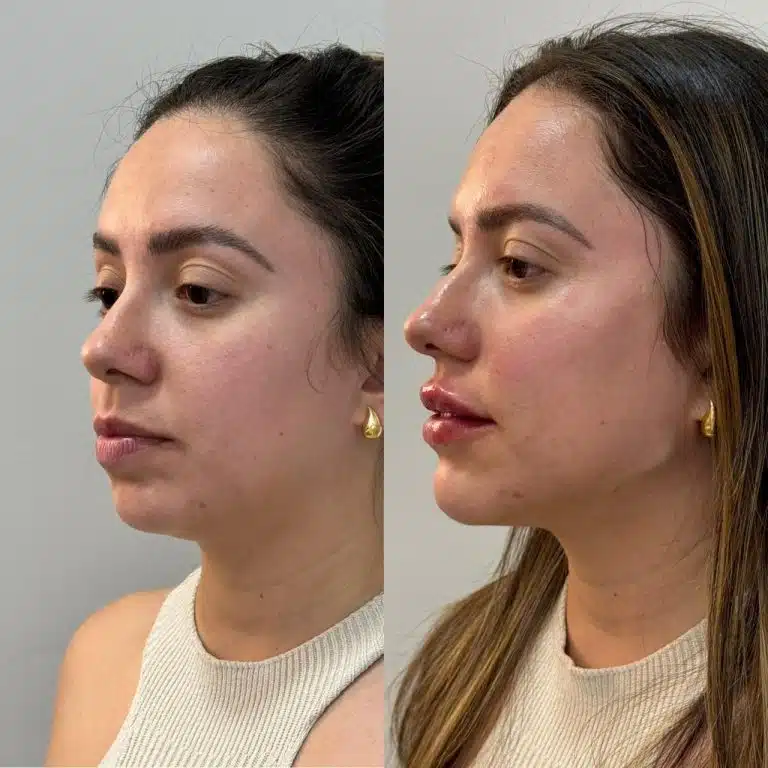 Harmonização facial BC