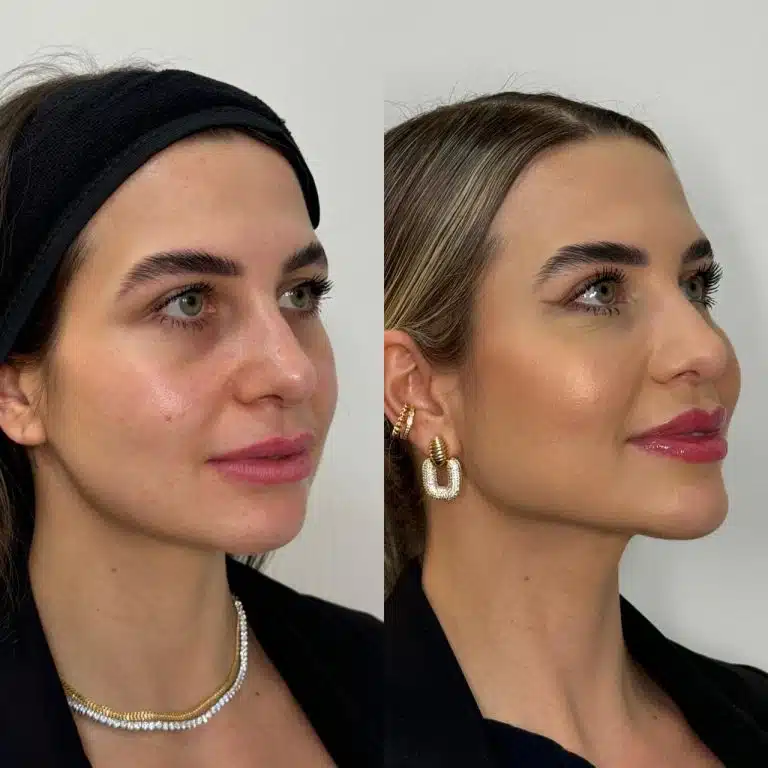 Full face harmonização
