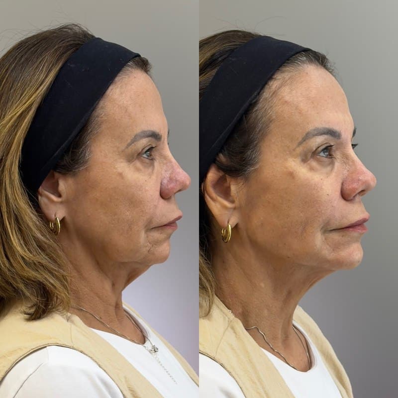 Resultado antes e depois