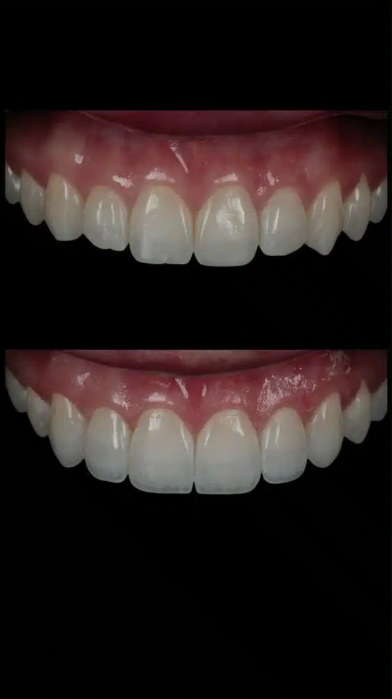 Resultado facetas em resina