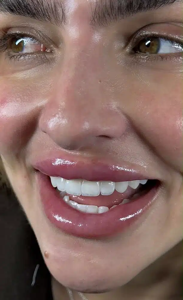 Resultado facetas em resina