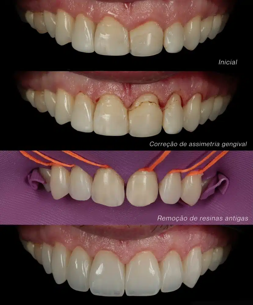 Resultado facetas em resina