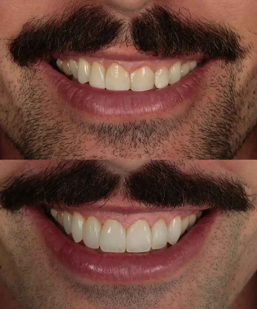 Resultado facetas em resina