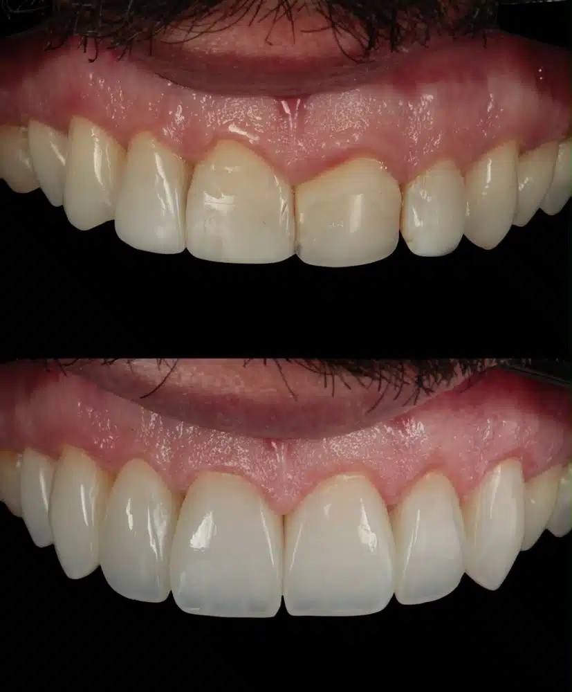 Resultado facetas em resina