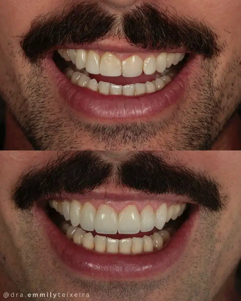 Resultado facetas em resina