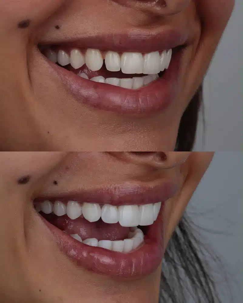 Resultado facetas em resina