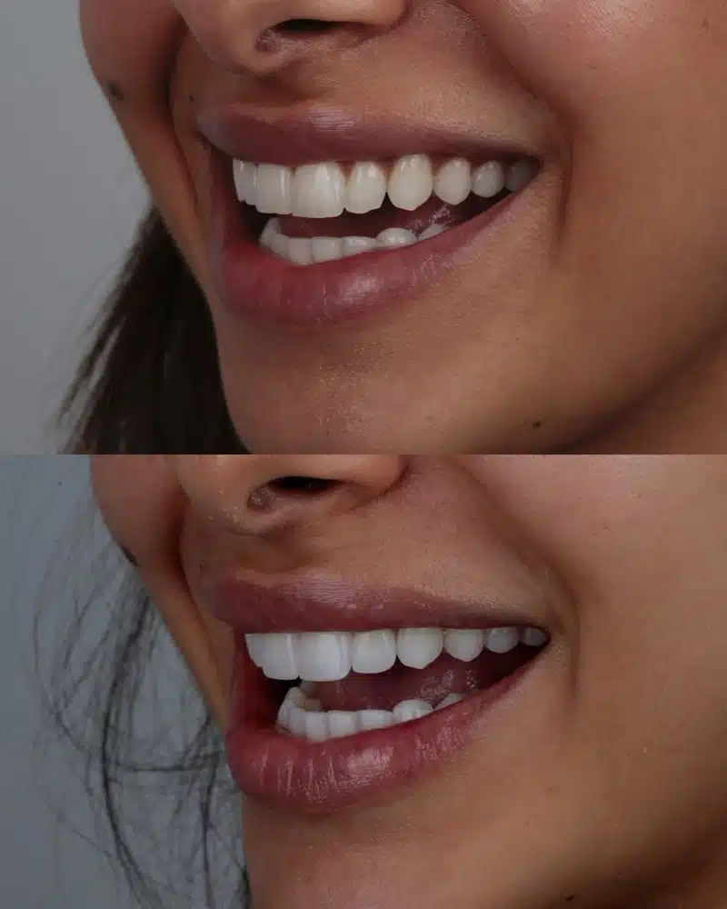 Resultado facetas em resina