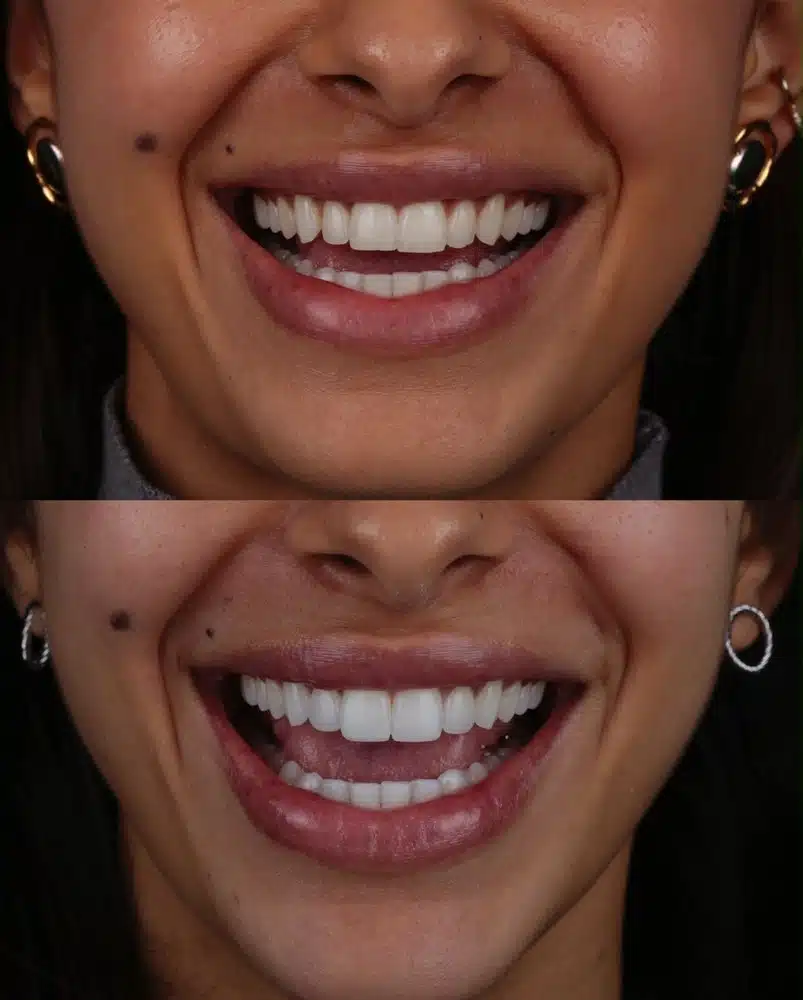 Resultado facetas em resina