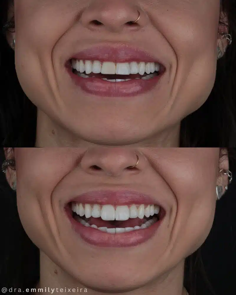 Resultado facetas em resina