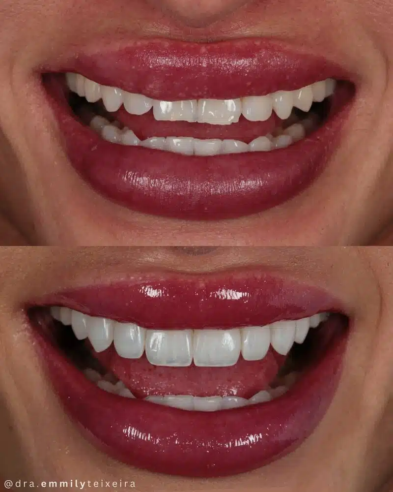 Resultado facetas em resina