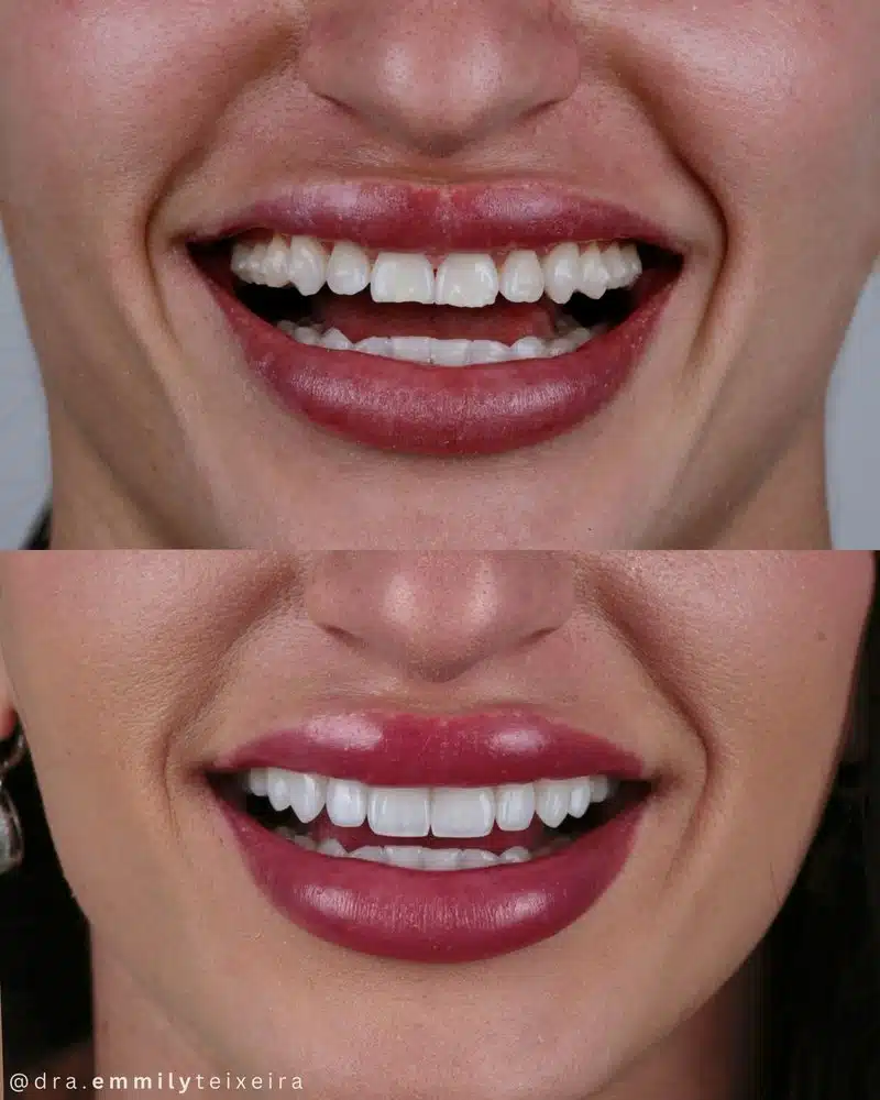 Resultado facetas em resina