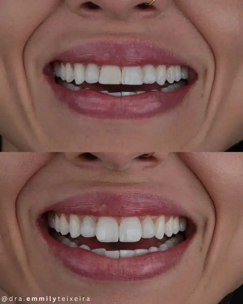 Resultado facetas em resina