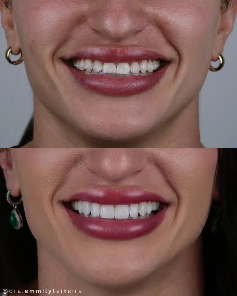 Resultado facetas em resina