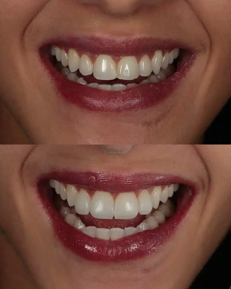 Resultado facetas em resina