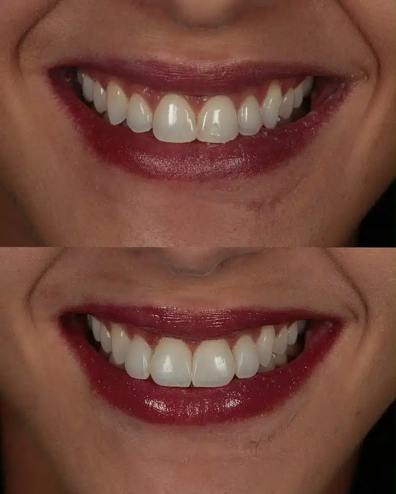 Resultado facetas em resina