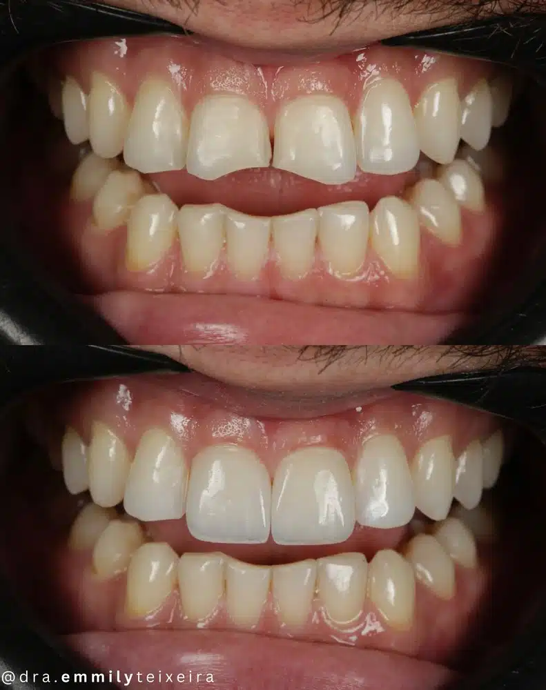 Resultado facetas em resina