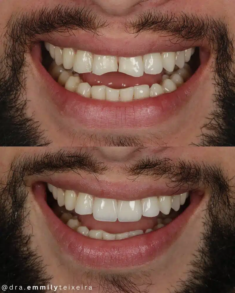 Resultado facetas em resina