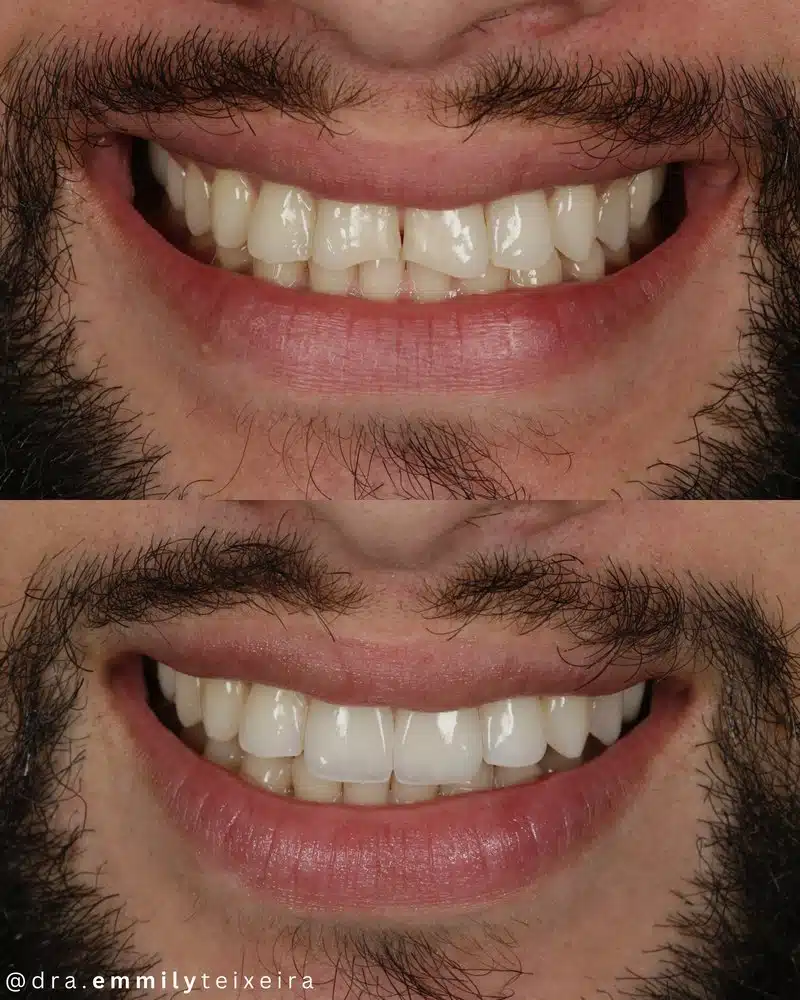 Resultado facetas em resina